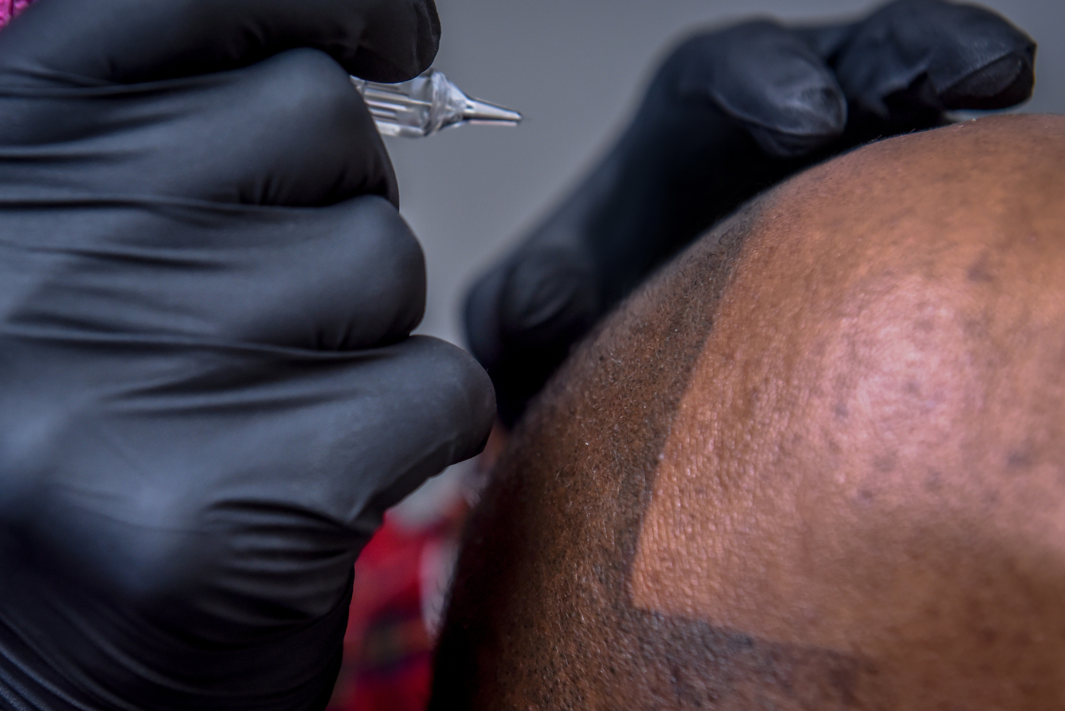 Birmingham Tattoo Removal by Dr Ink Eraser
